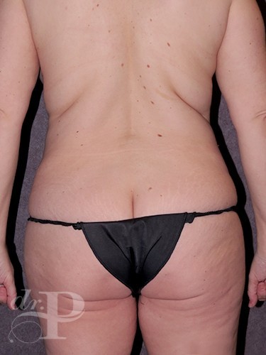 Case--29970 | Before True Form Tummy Tuck® with Lower Body Lift (Buttock Lift) 4