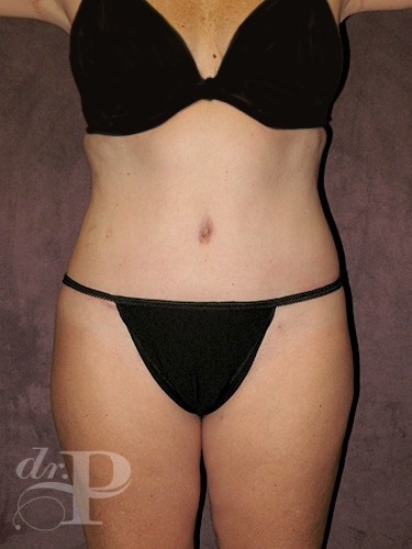 Case--29686 | After Lower Body Lift (Buttock Lift) 1