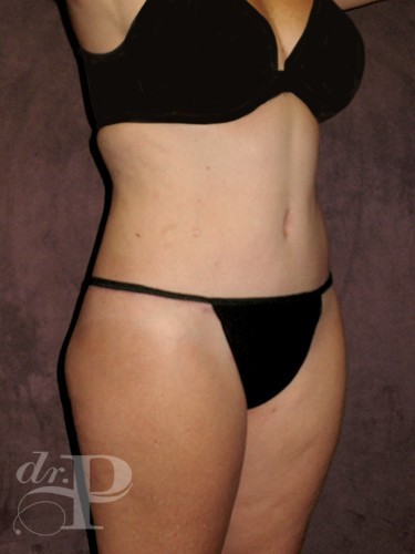 Case--29686 | After Lower Body Lift (Buttock Lift) 3