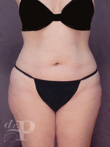 Case--29686 | Before Lower Body Lift (Buttock Lift) 1