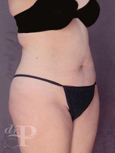 Case--29686 | Before Lower Body Lift (Buttock Lift) 3