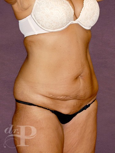 Case--29922 | Before Lower Body Lift (Buttock Lift) 2