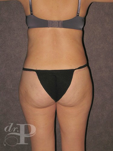 Case--30102 | After Lower Body Lift (Buttock Lift) 4