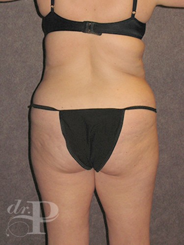 Case--30112 | Before True Form Tummy Tuck® with Lower Body Lift (Buttock Lift) 4