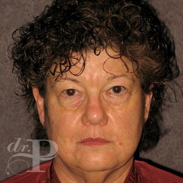 Case--29636 | Before Eyelid Surgery (Blepharoplasty) 1