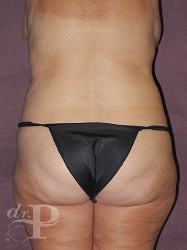 Case--29973 | After True Form Tummy Tuck® with Lower Body Lift (Buttock Lift) 4