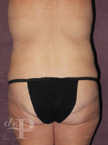 Case--29973 | Before True Form Tummy Tuck® with Lower Body Lift (Buttock Lift) 4