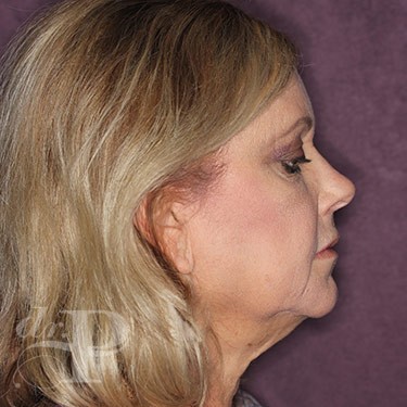 Case--31060 | Before Eyelid Surgery (Blepharoplasty) 5