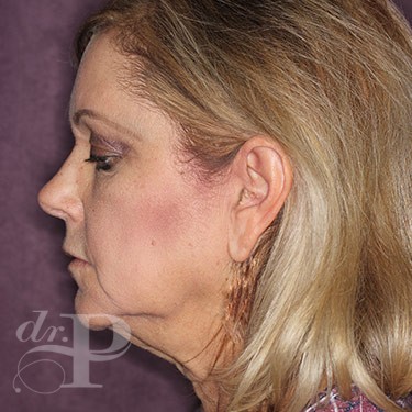 Case--31066 | Before Fat Grafting 3