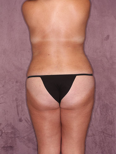 Case--34112 | After Fat Transfer to Buttocks 6