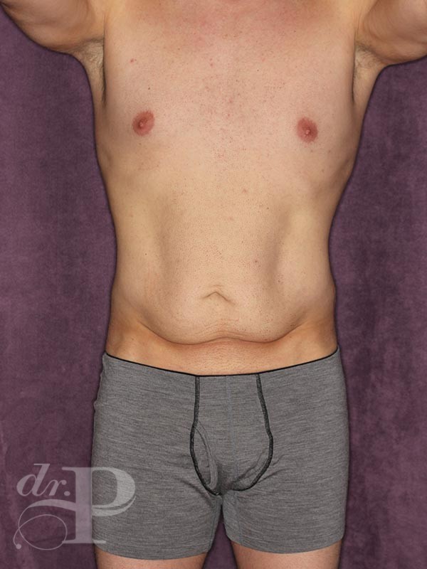 Case--27788 | Before True Form Tummy Tuck® for Men 1