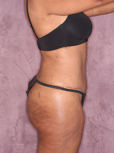Case--32419 | After Fat Transfer to Buttocks 4