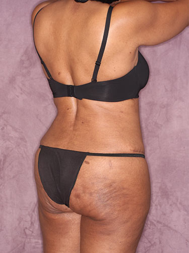 Case--32419 | After Fat Transfer to Buttocks 6