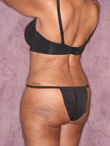 Case--32419 | After Fat Transfer to Buttocks 5
