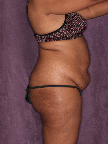 Case--32419 | Before Fat Transfer to Buttocks 4