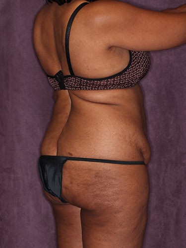 Case--32419 | Before Fat Transfer to Buttocks 6