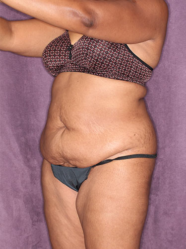 Case--32419 | Before Fat Transfer to Buttocks 3