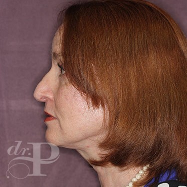 Case--31251 | After Eyelid Surgery (Blepharoplasty) 3