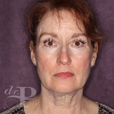 Case--31251 | Before Eyelid Surgery (Blepharoplasty) 1