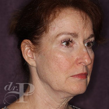 Case--31251 | Before Eyelid Surgery (Blepharoplasty) 4