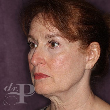 Case--31251 | Before Eyelid Surgery (Blepharoplasty) 2