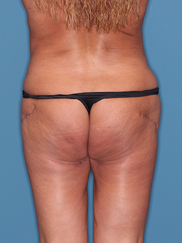 Case--39628 | After Thigh Lift 6