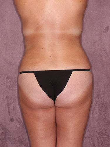 Case--36144 | After Fat Transfer to Buttocks 6