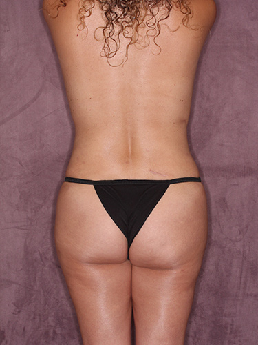 Case--36097 | After Fat Transfer to Buttocks 6