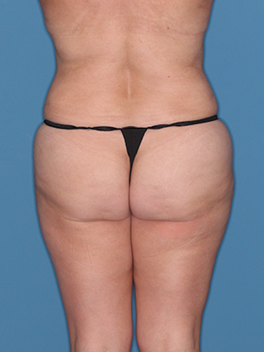 Case--39208 | After True Form Tummy Tuck® in Overweight & Weight Loss Patients 6