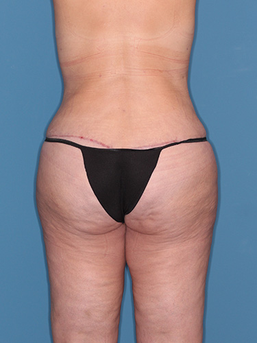 Case--39430 | After Lower Body Lift (Buttock Lift) 6