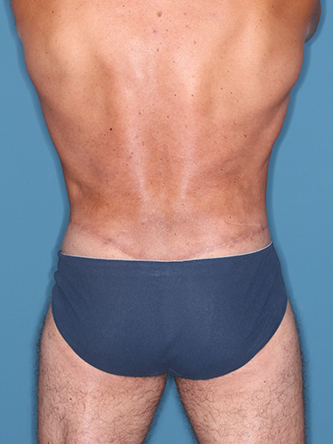Case--36808 | After True Form Tummy Tuck® for Men 6