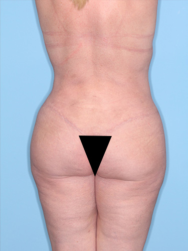 Case--37163 | After True Form Tummy Tuck® with Lower Body Lift (Buttock Lift) 6