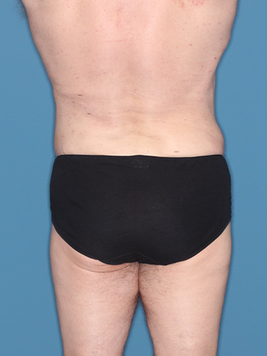 Case--36843 | After True Form Tummy Tuck® for Men 6
