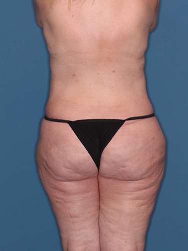 Case--40335 | After True Form Tummy Tuck® in Overweight & Weight Loss Patients 6