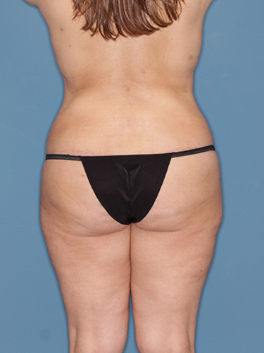 Case--39995 | After True Form Tummy Tuck® with Lower Body Lift (Buttock Lift) 6