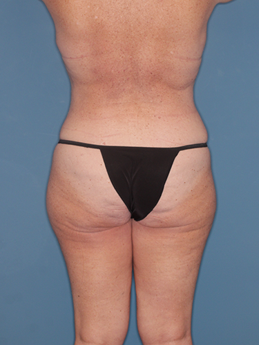 Case--45006 | After Breast Lift with Breast Reduction 6