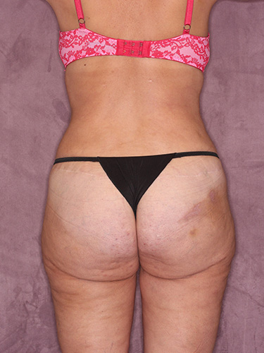 Case--39670 | After Thigh Lift 6
