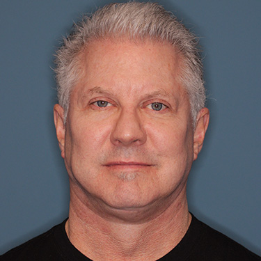 Case--40290 | After Facelift and Neck Lift for Men 1