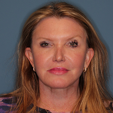 Case--41496 | After Eyelid Surgery (Blepharoplasty) 1
