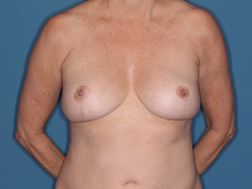 Case--37257 | After Breast Lift with Breast Reduction 1