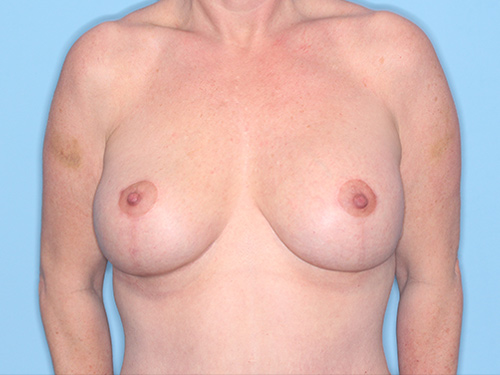 Case--37177 | After Breast Augmentation and Breast Lift 1