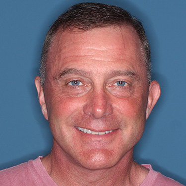 Case--41459 | After Facelift and Neck Lift for Men 1
