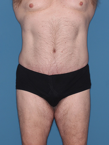 Case--36843 | After True Form Tummy Tuck® for Men 1