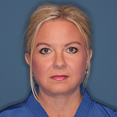 Case--39150 | After Eyelid Surgery (Blepharoplasty) 1