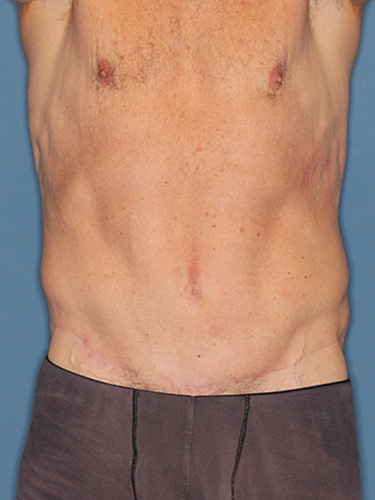Case--40026 | After True Form Tummy Tuck® for Men 1