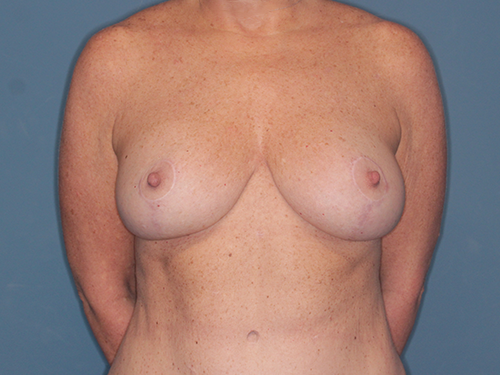 Case--45021 | After Breast Lift 1