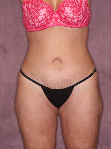 Case--39670 | After Thigh Lift 1