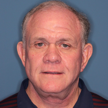 Case--40393 | After Facelift and Neck Lift for Men 1