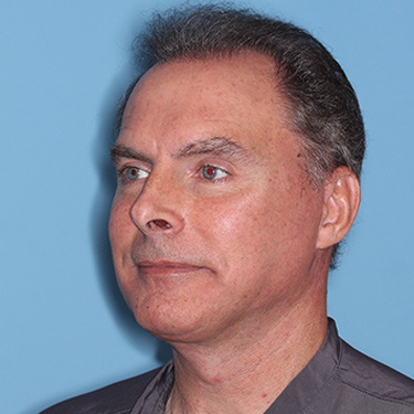 Case--36831 | After Facelift and Neck Lift for Men 3