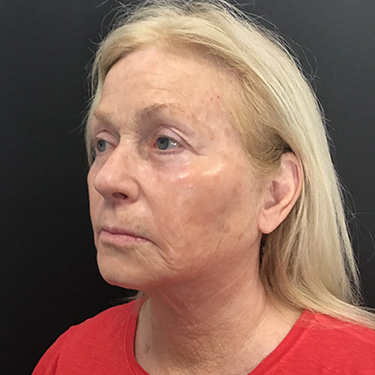 Case--39696 | After Eyelid Surgery (Blepharoplasty) 3